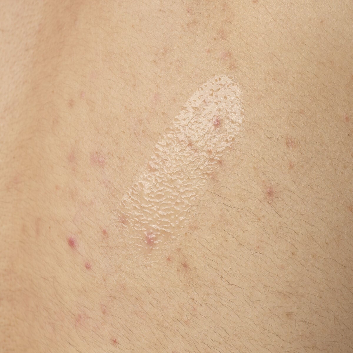 salicylic-acid-0-5-body-serum-r8 ORD-salicylic-acid-05-body-240ml-application.jpg