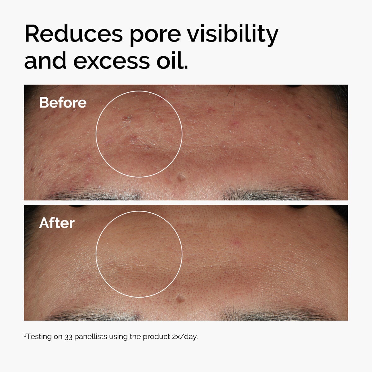 niacinamide-10-zinc-1-d4 ord-niacinamide-zinc-blemish-serum-before-after-pores.jpg