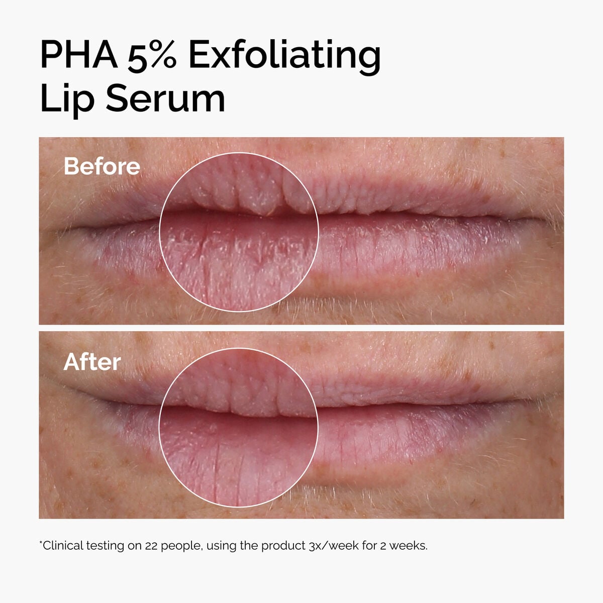 pha-5-exfoliating-lip-serum-x3 ord-pha-5pct-lip-exfoliating-serum-before-after.jpg