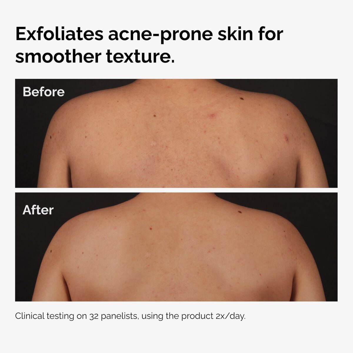 salicylic-acid-0-5-body-serum-r8 ord-salicylic-acid-body-serum-before-after-graphic-NA.jpg