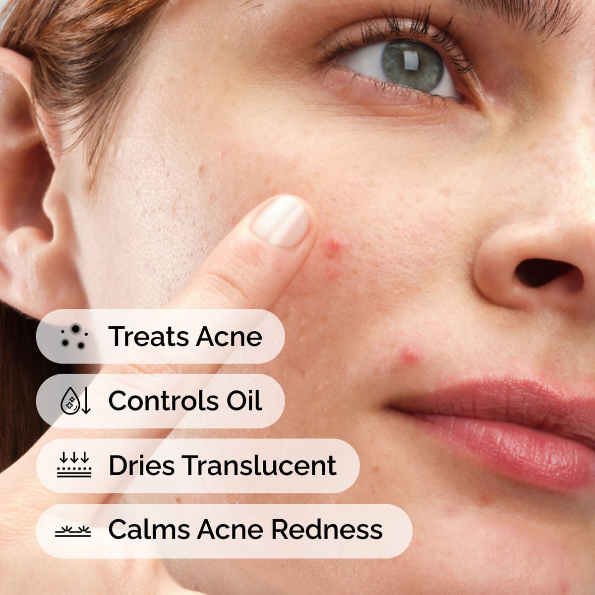 sulfur-10-powder-to-cream-concentrate-y5 ord-sulfur-10pct-powder-to-cream-concentrate-model-application-with-benefits-acne.jpg