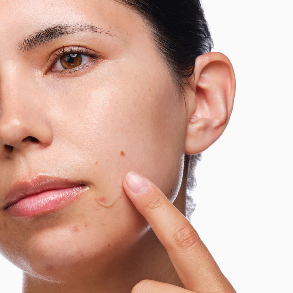 the-acne-set-c3 rdn-the-acne-set-application.png